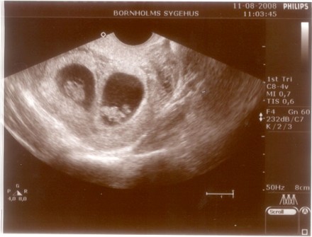 Gravid uge 8 8. graviditetsuge