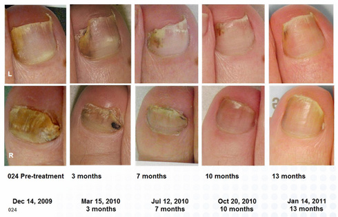 Using bleach for nail fungus: is it effective?